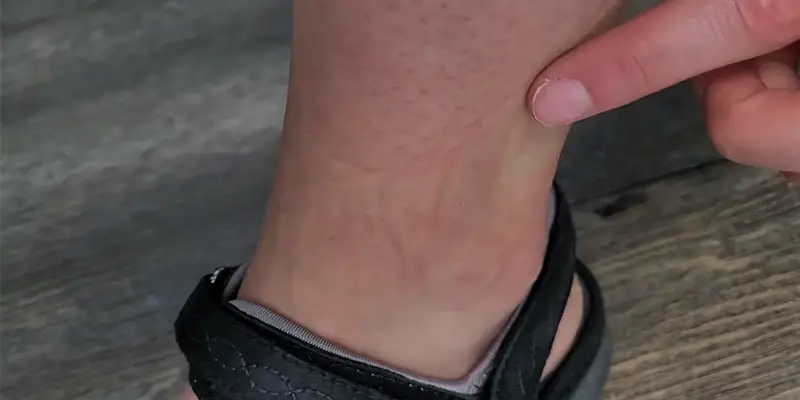 Socks Marks on Legs